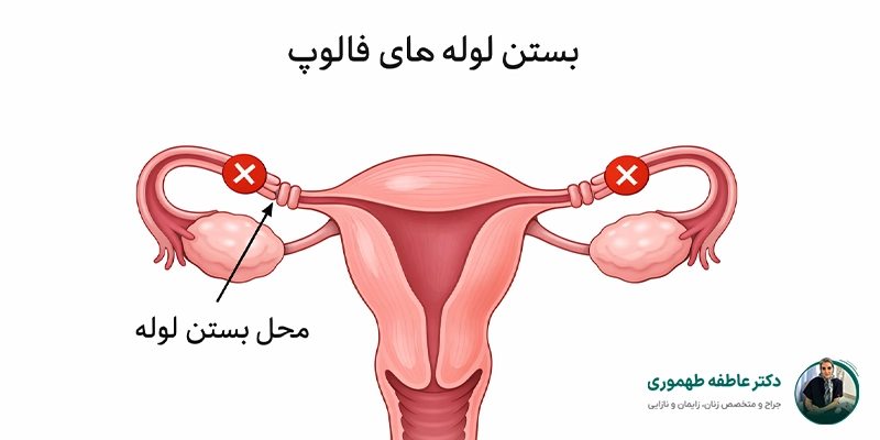 بستن لوله های رحم چیست