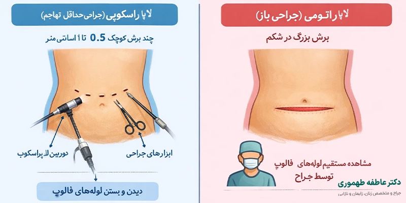 تفاوت بستن لوله های رحم از لاپاراسکوپی و جراحی باز